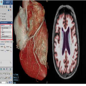 Intellispace-Portal-for-CT-and-MRI_thumb_1
