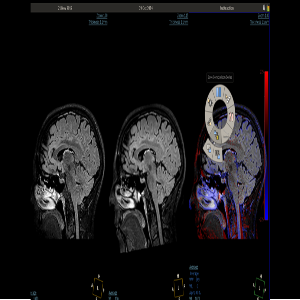 PHILIPS-INTELLISPACE-PORTAL-FOR-NEURO-AND-ONCOLOGY-MRI_thumb_1